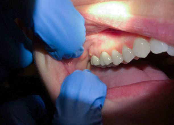 Best Emergency Tooth Extraction in Mapleton, ND